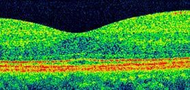 Immagine OCT spectral domain ad alta risoluzione di retina normale. Sono evidenti i vari strati retinici e lo strato dell’epitelio pigmentato-coriocapillare, più reflettente, di colore rosso. Sotto la retina si distinguono i vasi più superficiali della coroide. Al centro della scansione si nota la depressione normale, a livello della fovea, che è il punto più sensibile dell’occhio e che serve alla visione dei dettagli, per esempio leggere o cucire.
