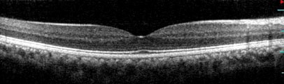 Immagine OCT spectral domain ad alta risoluzione di retina normale Bianco e nero l’OCT rappresentato nella figura 2 è in bianco e nero cioè con la scala dei grigi. Queste immagini sembrano meno belle di quelle a colori ma sono molto più utili per gli specialisti perché permettono di studiare dei dettagli che non sono evidenti sulle immagini a colori. Per questo gli OCT destinati ad altri oculisti sono quasi sempre stampati in bianco e nero.