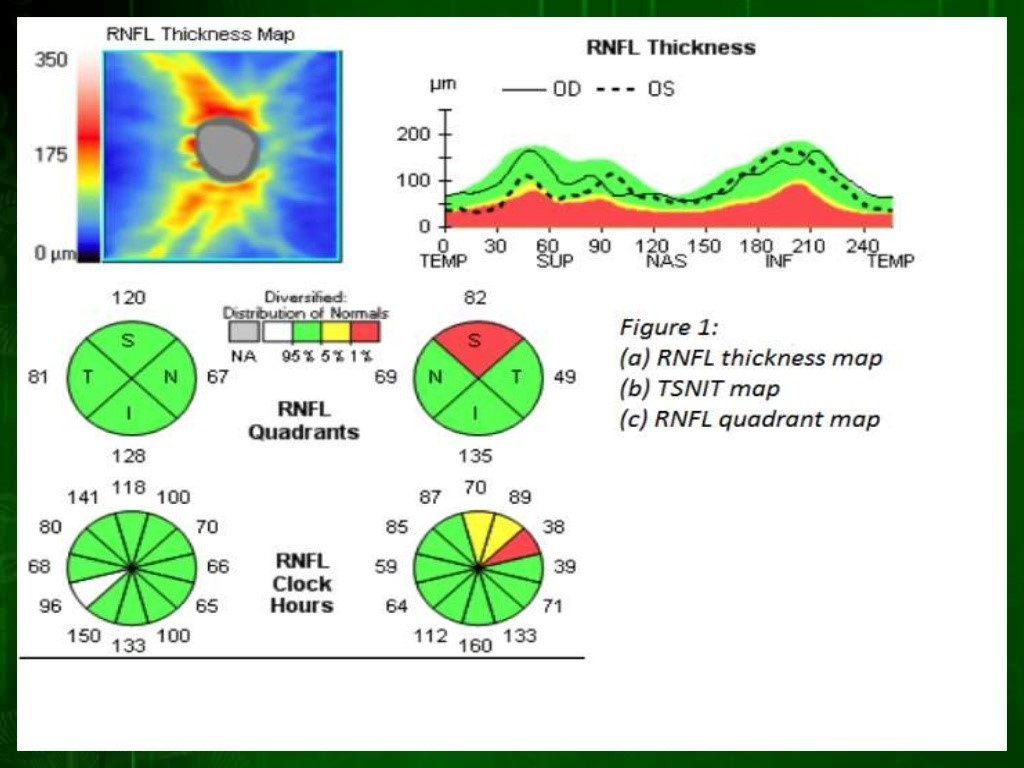 8-riduzione-spessore-fibre-nervose-glaucoma