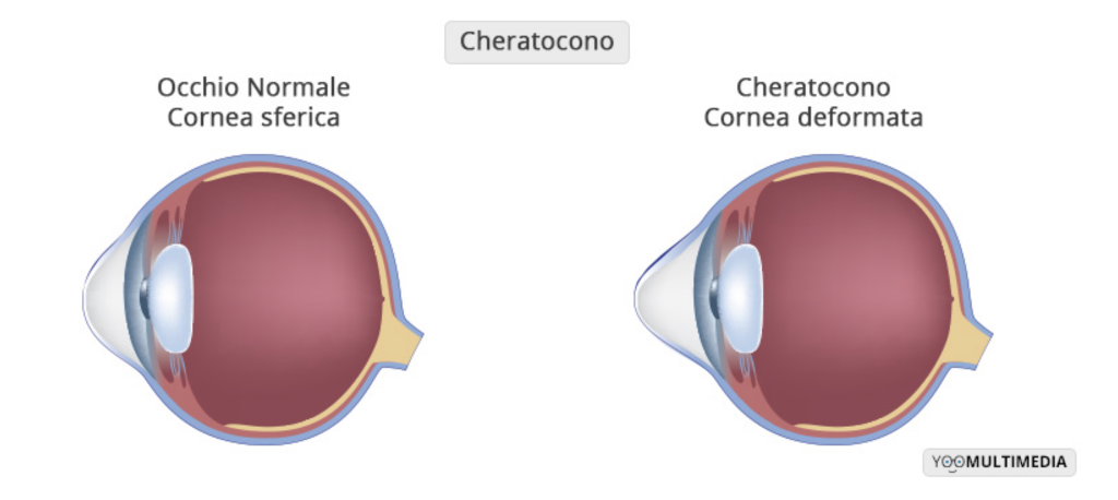 cheratono